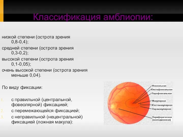 низкой степени (острота зрения 0,8-0,4); средней степени (острота зрения 0,3-0,2); высокой