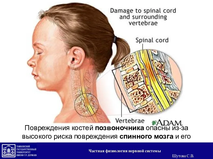 Повреждения костей позвоночника опасны из-за высокого риска повреждения спинного мозга и