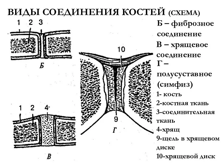 Б – фиброзное соединение ВИДЫ СОЕДИНЕНИЯ КОСТЕЙ (СХЕМА) В – хрящевое