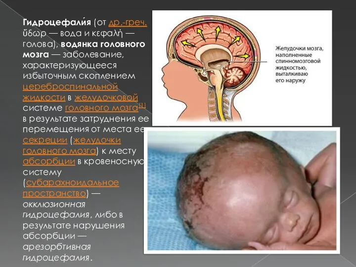 Гидроцефали́я (от др.-греч. ὕδωρ — вода и κεφαλή — голова), водянка