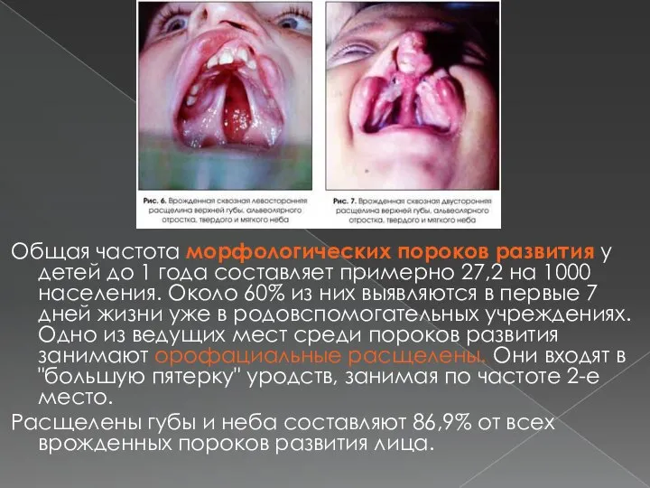 Общая частота морфологических пороков развития у детей до 1 года составляет