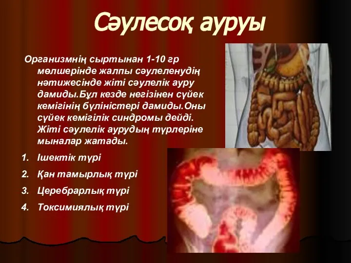 Сәулесоқ ауруы Организмнің сыртынан 1-10 гр мөлшерінде жалпы сәулеленудің нәтижесінде жіті