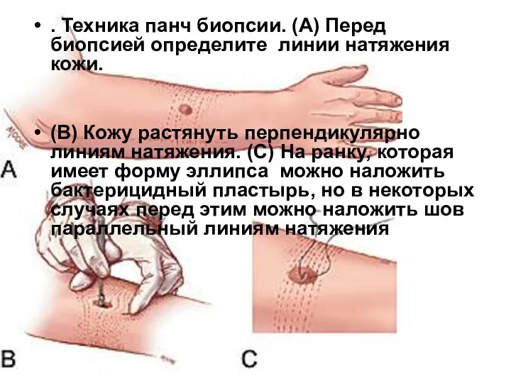 . Техника панч биопсии. (А) Перед биопсией определите линии натяжения кожи.