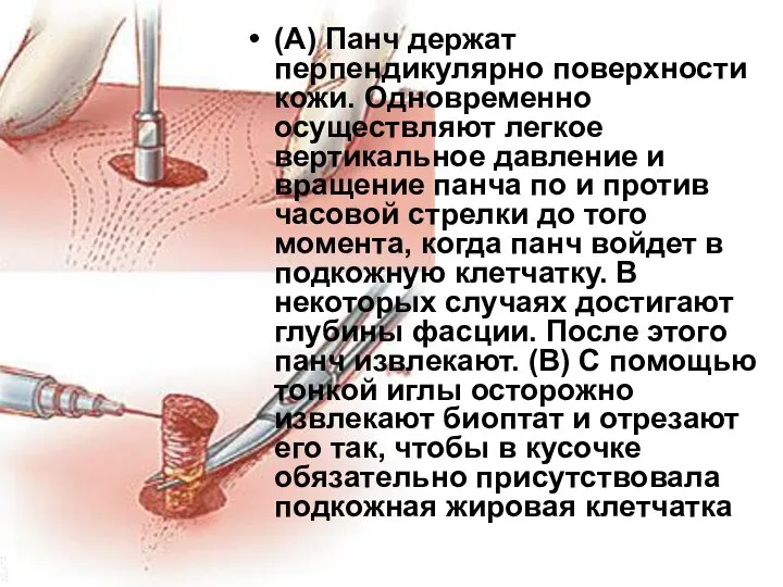 (А) Панч держат перпендикулярно поверхности кожи. Одновременно осуществляют легкое вертикальное давление