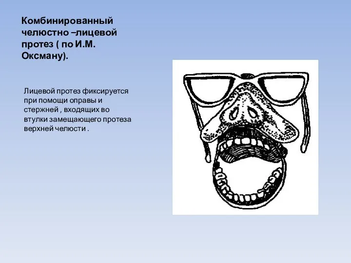 Комбинированный челюстно –лицевой протез ( по И.М. Оксману). Лицевой протез фиксируется