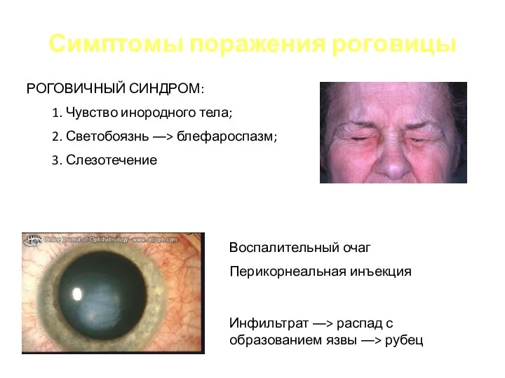 Симптомы поражения роговицы РОГОВИЧНЫЙ СИНДРОМ: 1. Чувство инородного тела; 2. Светобоязнь