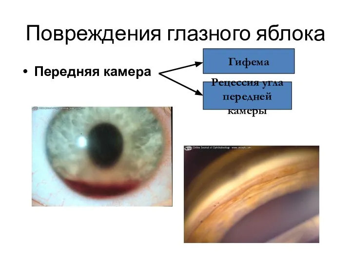 Повреждения глазного яблока Передняя камера Гифема Рецессия угла передней камеры