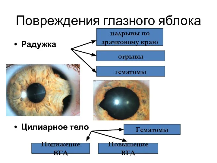 Повреждения глазного яблока Радужка Цилиарное тело надрывы по зрачковому краю отрывы