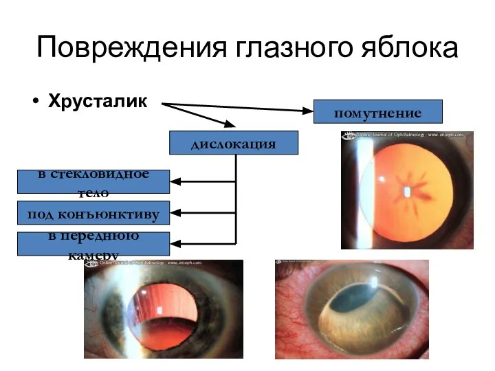 Повреждения глазного яблока Хрусталик дислокация помутнение под конъюнктиву в стекловидное тело в переднюю камеру