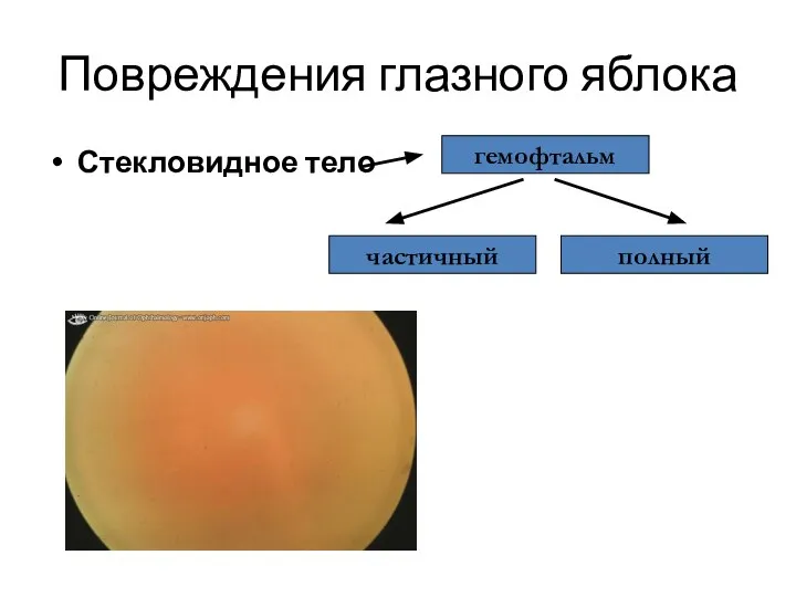 Повреждения глазного яблока Стекловидное тело частичный полный гемофтальм