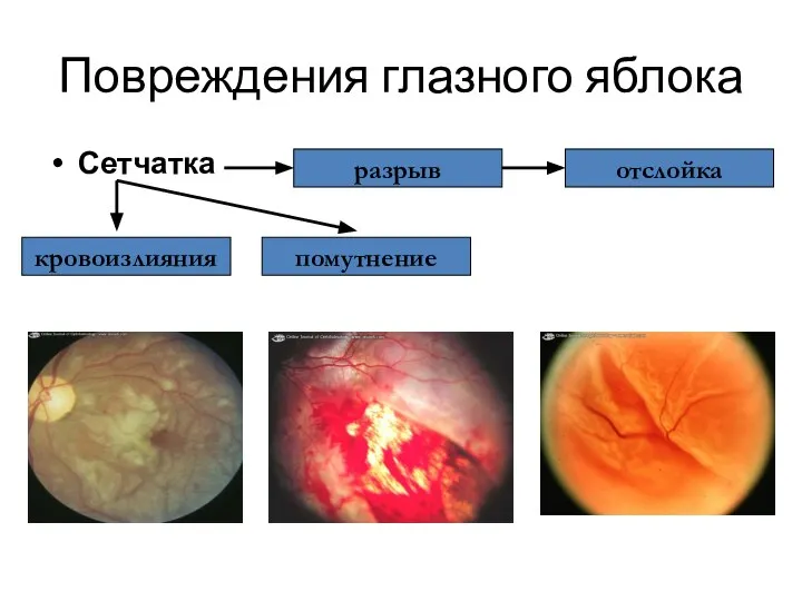 Повреждения глазного яблока Сетчатка кровоизлияния отслойка помутнение разрыв