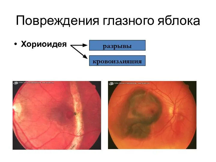 Повреждения глазного яблока Хориоидея разрывы кровоизлияния