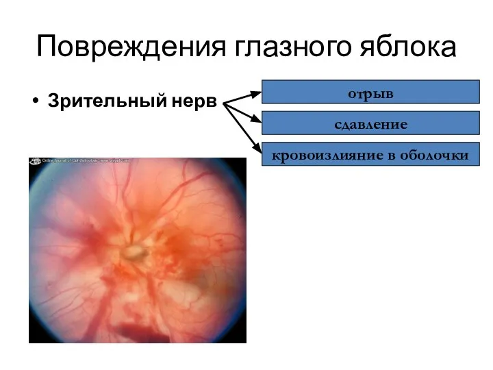 Повреждения глазного яблока Зрительный нерв отрыв сдавление кровоизлияние в оболочки