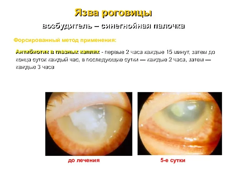 Язва роговицы возбудитель – синегнойная палочка Форсированный метод применения: Антибиотик в