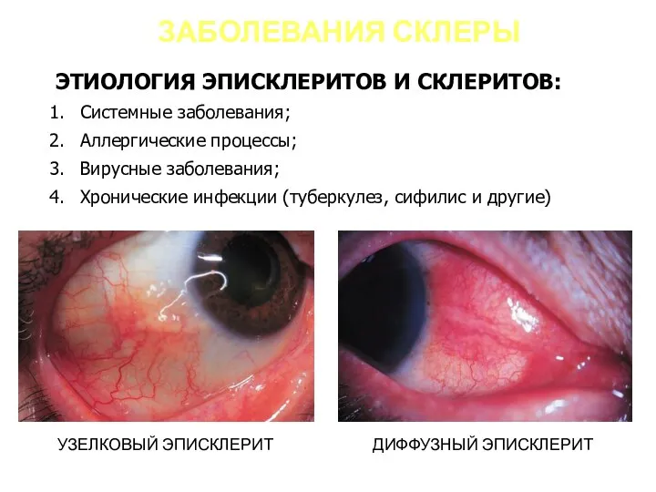 ЗАБОЛЕВАНИЯ СКЛЕРЫ ЭТИОЛОГИЯ ЭПИСКЛЕРИТОВ И СКЛЕРИТОВ: Системные заболевания; Аллергические процессы; Вирусные