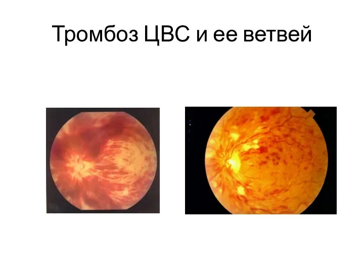 Тромбоз ЦВС и ее ветвей