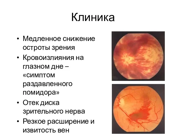 Клиника Медленное снижение остроты зрения Кровоизлияния на глазном дне – «симптом