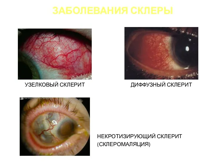 ЗАБОЛЕВАНИЯ СКЛЕРЫ УЗЕЛКОВЫЙ СКЛЕРИТ ДИФФУЗНЫЙ СКЛЕРИТ НЕКРОТИЗИРУЮЩИЙ СКЛЕРИТ (СКЛЕРОМАЛЯЦИЯ)