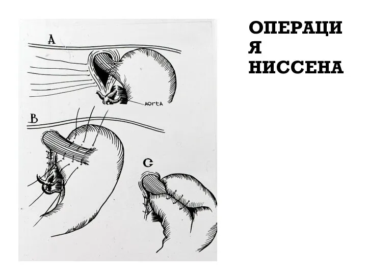 ОПЕРАЦИЯ НИССЕНА