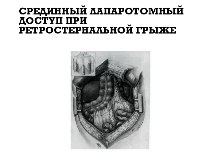 СРЕДИННЫЙ ЛАПАРОТОМНЫЙ ДОСТУП ПРИ РЕТРОСТЕРНАЛЬНОЙ ГРЫЖЕ