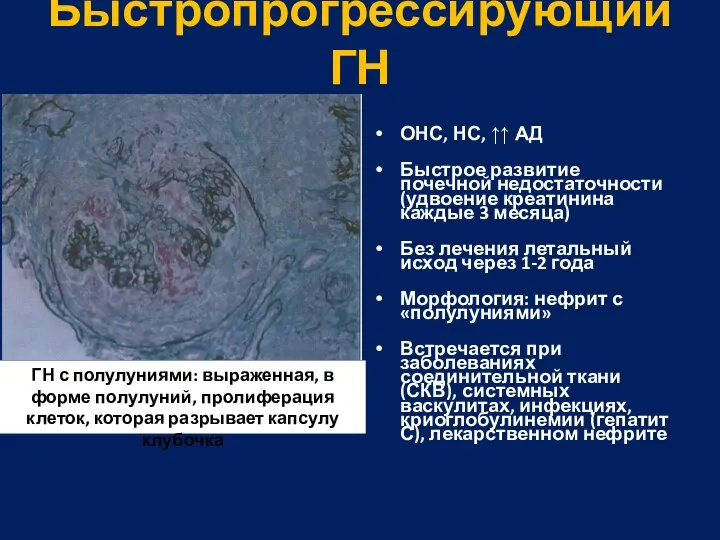 Быстропрогрессирующий ГН ОНС, НС, ↑↑ АД Быстрое развитие почечной недостаточности (удвоение