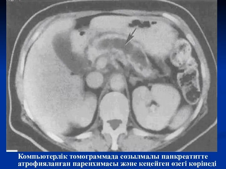 Компьютерлік томограммада созылмалы панкреатитте атрофияланған паренхимасы және кеңейген өзегі көрінеді