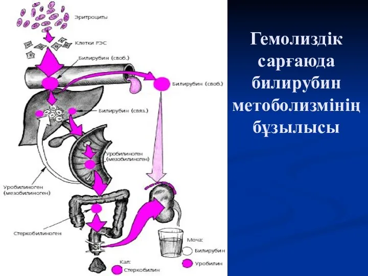 Гемолиздік сарғаюда билирубин метоболизмінің бұзылысы