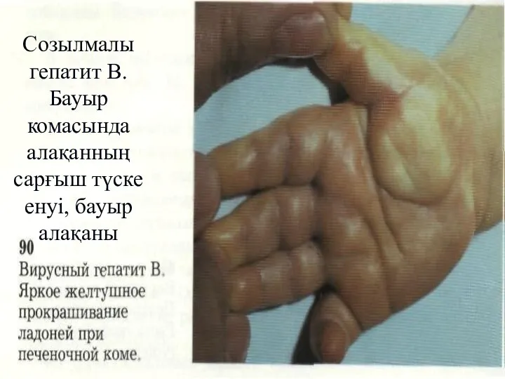 Созылмалы гепатит В. Бауыр комасында алақанның сарғыш түске енуі, бауыр алақаны