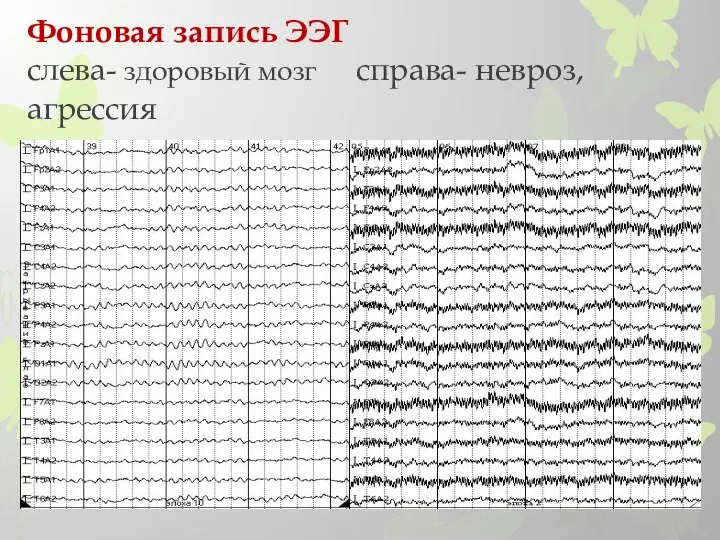 Фоновая запись ЭЭГ слева- здоровый мозг справа- невроз, агрессия