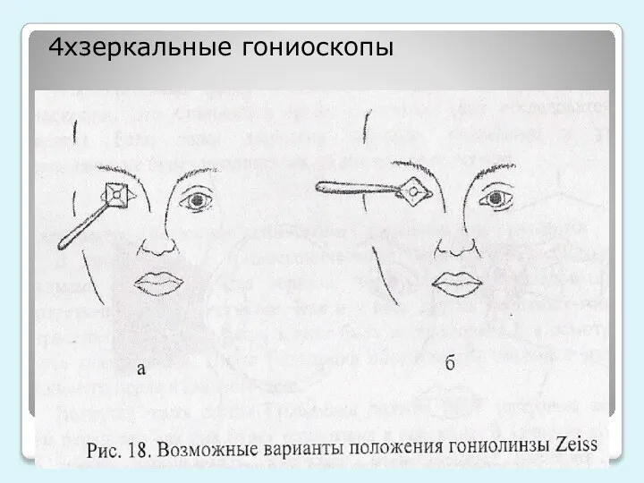 4хзеркальные гониоскопы