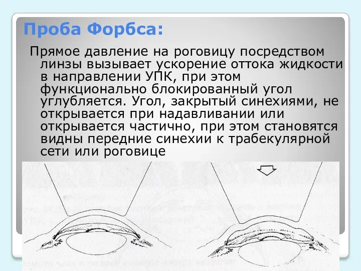 Проба Форбса: Прямое давление на роговицу посредством линзы вызывает ускорение оттока