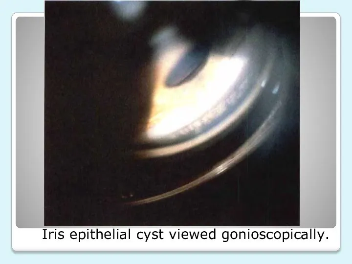 Iris epithelial cyst viewed gonioscopically.