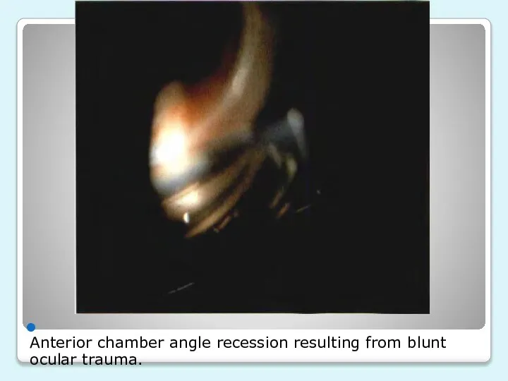 Anterior chamber angle recession resulting from blunt ocular trauma.