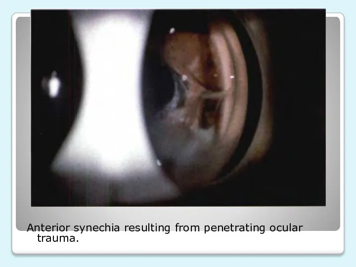 Anterior synechia resulting from penetrating ocular trauma.