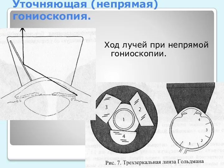 Уточняющая (непрямая) гониоскопия. Ход лучей при непрямой гониоскопии.