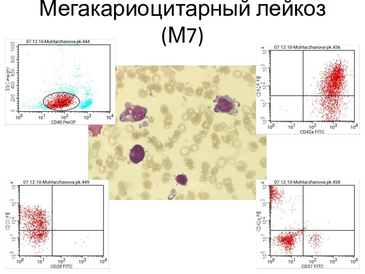 Мегакариоцитарный лейкоз (М7)