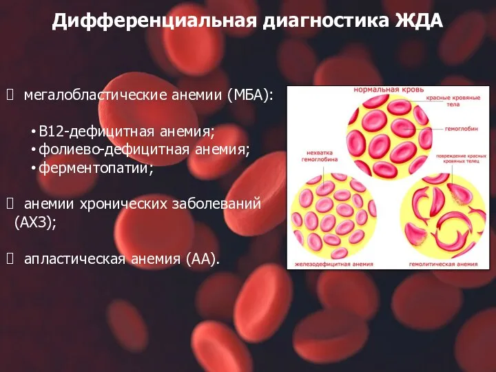 Дифференциальная диагностика ЖДА мегалобластические анемии (МБА): В12-дефицитная анемия; фолиево-дефицитная анемия; ферментопатии;