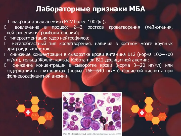 макроцитарная анемия (MCV более 100 фл); вовлечение в процесс 2—3 ростков