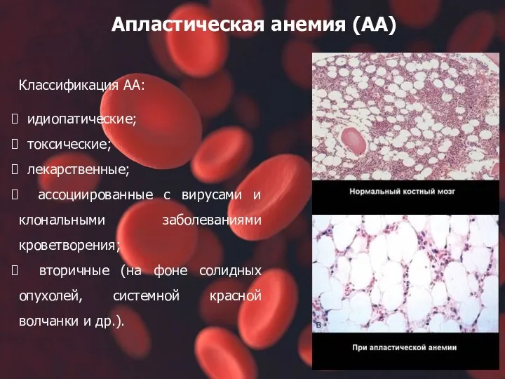 Апластическая анемия (АА) Классификация АА: идиопатические; токсические; лекарственные; ассоциированные с вирусами