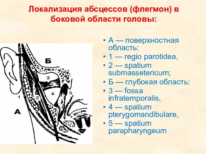 Локализация абсцессов (флегмон) в боковой области головы: А — поверхностная область: