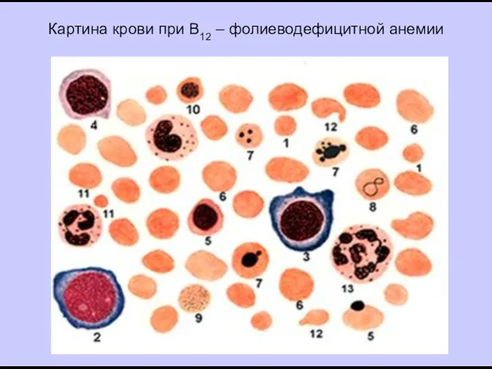 Картина крови при В12 – фолиеводефицитной анемии