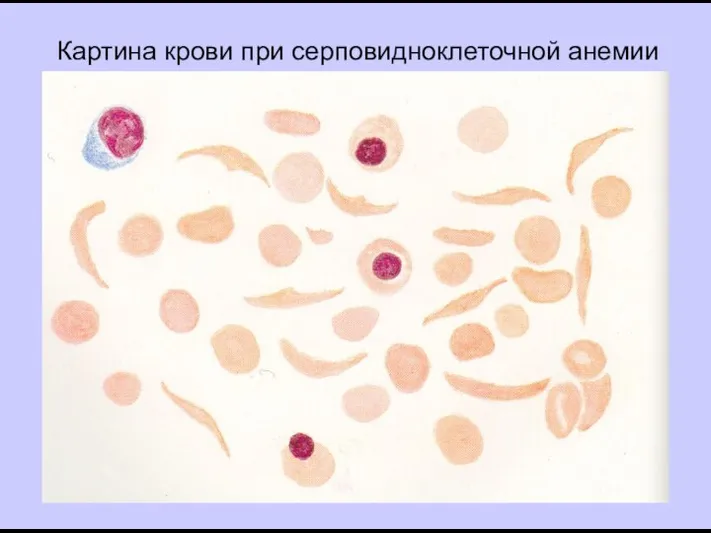 Картина крови при серповидноклеточной анемии