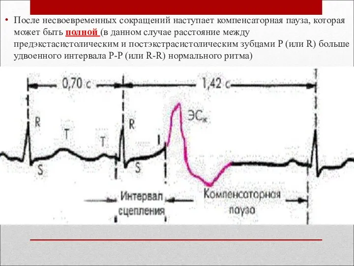 После несвоевременных сокращений наступает компенсаторная пауза, которая может быть полной (в