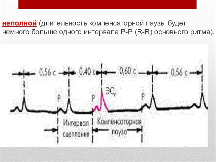 неполной (длительность компенсаторной паузы будет немного больше одного интервала Р-Р (R-R) основного ритма).