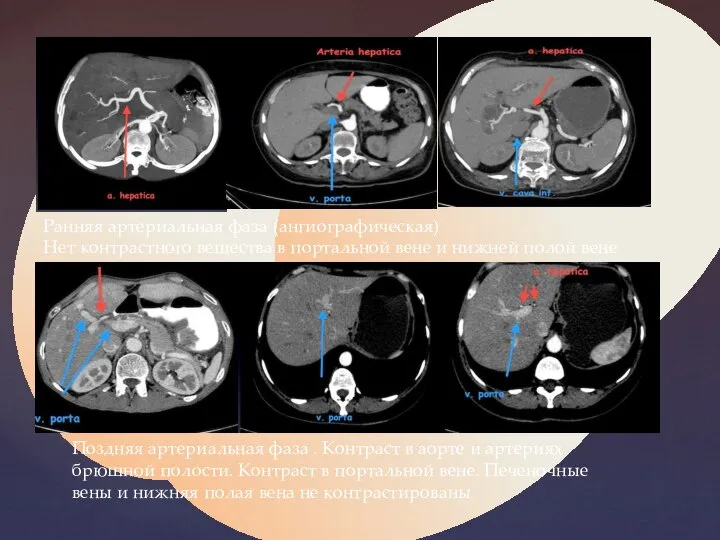 Ранняя артериальная фаза (ангиографическая) Нет контрастного вещества в портальной вене и