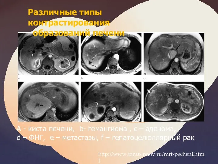 Различные типы контрастирования образований печени A - киста печени, b- гемангиома