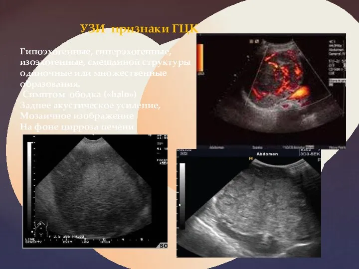 УЗИ признаки ГЦК Гипоэхогенные, гиперэхогенные, изоэхогенные, смешанной структуры одиночные или множественные