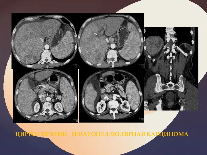 ЦИРРОЗ ПЕЧЕНИ. ГЕПАТОЦЕЛЛЮЛЯРНАЯ КАРЦИНОМА