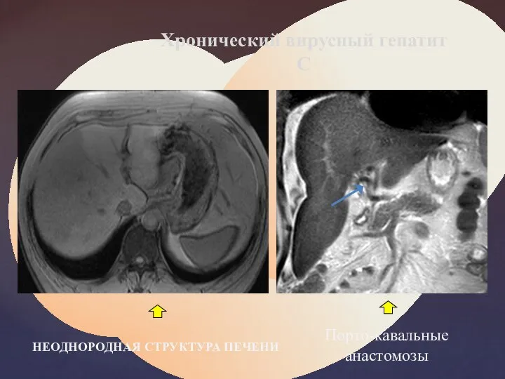 Хронический вирусный гепатит С Порто-кавальные анастомозы НЕОДНОРОДНАЯ СТРУКТУРА ПЕЧЕНИ