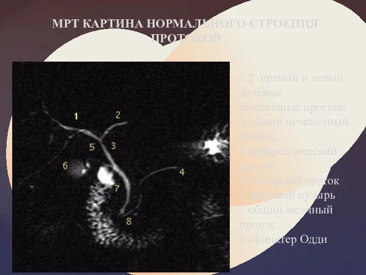 МРТ КАРТИНА НОРМАЛЬНОГО СТРОЕНИЯ ПРОТОКОВ 1,2 правый и левый долевые печеночные